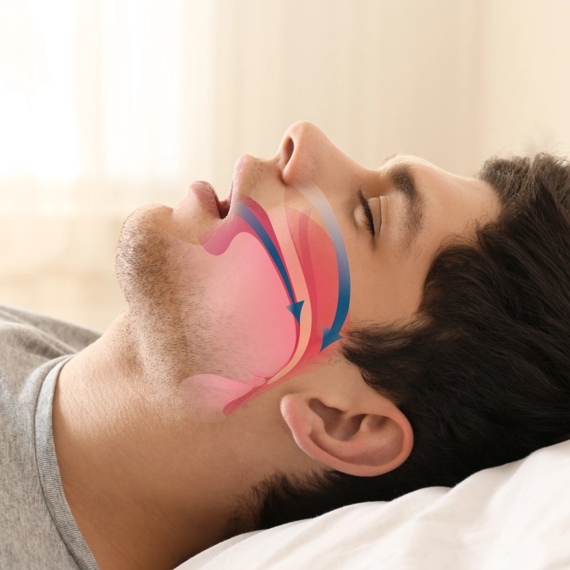 Sleep Apnoea Care