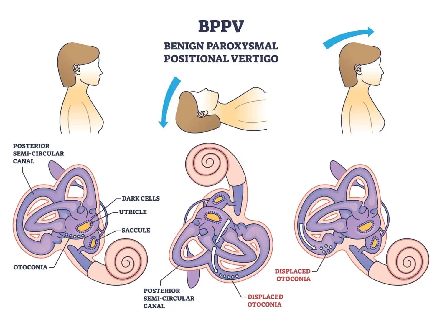 BPPV and Balance Disorder Treatment