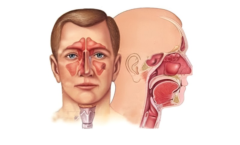 Nose Sinus Allergy